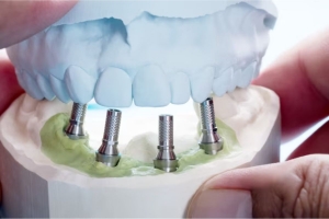 How to Choose the Best Dental Implants Dentist in Lethbridge